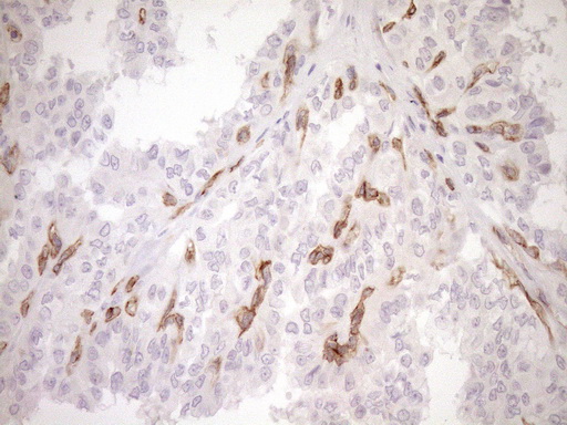 BLNK Antibody - Immunohistochemical staining of paraffin-embedded Carcinoma of Human thyroid tissue using anti-BLNK mouse monoclonal antibody. (Heat-induced epitope retrieval by 1mM EDTA in 10mM Tris buffer. (pH8.5) at 120°C for 3 min. (1:150)