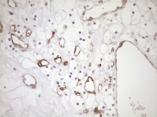 BLNK Antibody - Immunohistochemical staining of paraffin-embedded Carcinoma of Human kidney tissue using anti-BLNK mouse monoclonal antibody. (Heat-induced epitope retrieval by 1mM EDTA in 10mM Tris buffer. (pH8.5) at 120°C for 3 min. (1:150)