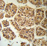 BLNK Antibody - BLNK Antibody (RB18883) IHC of formalin-fixed and paraffin-embedded human hepatocarcinoma followed by peroxidase-conjugated secondary antibody and DAB staining.
