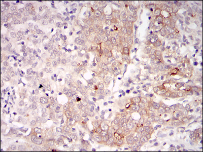 BLNK Antibody - IHC of paraffin-embedded human cervical cancer tissues using BLNK mouse monoclonal antibody with DAB staining.