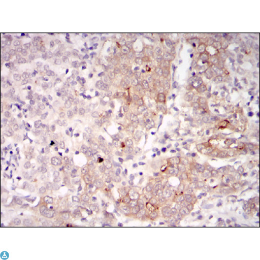 BLNK Antibody - Immunohistochemistry (IHC) analysis of paraffin-embedded human cervical cancer tissues with DAB staining using BLNK Monoclonal Antibody.