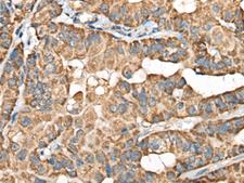 BLNK Antibody - Immunohistochemistry of paraffin-embedded Human thyroid cancer tissue  using BLNK Polyclonal Antibody at dilution of 1:40(×200)