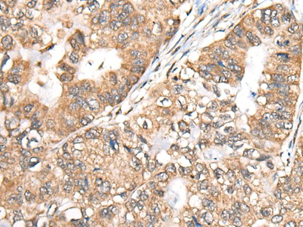 BLNK Antibody - Immunohistochemistry of paraffin-embedded Human gastric cancer tissue  using BLNK Polyclonal Antibody at dilution of 1:40(×200)
