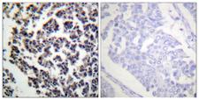 BLNK Antibody - Immunohistochemistry analysis of paraffin-embedded human lymph node, using BLNK (Phospho-Tyr96) Antibody. The picture on the right is blocked with the phospho peptide.