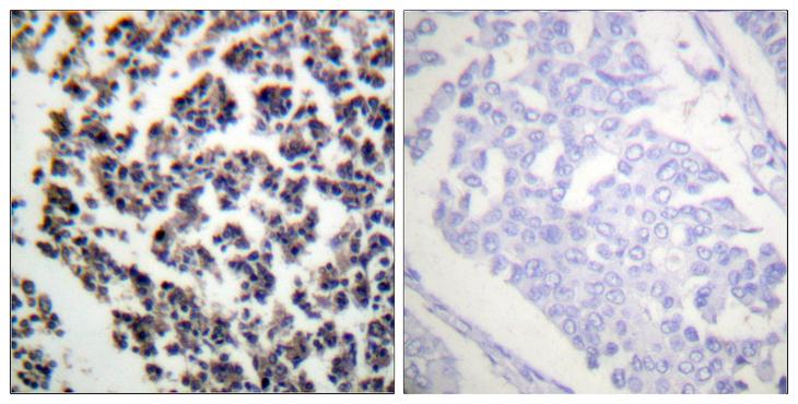 BLNK Antibody - P-peptide - + Immunohistochemistry analysis of paraffin-embedded human lymph node tissue using BLNK (Phospho-Tyr96) antibody.