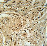 BLOC1S2 Antibody - BLOC1S2 Antibody immunohistochemistry of formalin-fixed and paraffin-embedded human cervix carcinoma followed by peroxidase-conjugated secondary antibody and DAB staining.