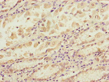 BLOC1S2 Antibody - Immunohistochemistry of paraffin-embedded human gastric cancer at dilution of 1:100
