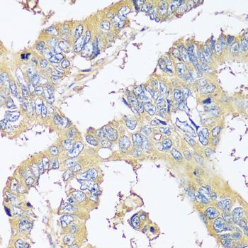 BLOC1S3 Antibody - Immunohistochemistry of paraffin-embedded Human colon carcinoma using BLOC1S3 Polyclonal Antibody at dilution of 1:100 (40x lens).