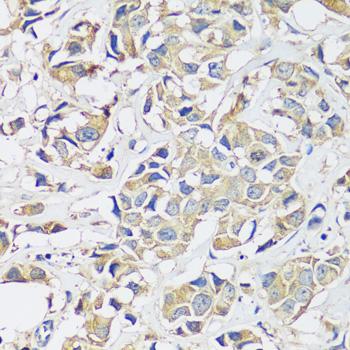 BLOC1S3 Antibody - Immunohistochemistry of paraffin-embedded Human breast cancer using BLOC1S3 Polyclonal Antibody at dilution of 1:100 (40x lens).