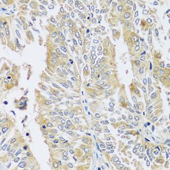 BLOC1S3 Antibody - Immunohistochemistry of paraffin-embedded Human uterine cancer using BLOC1S3 Polyclonal Antibody at dilution of 1:100 (40x lens).