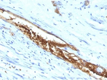 Blood Group A Antibody - Formalin-fixed, paraffin-embedded human colon carcinoma stained with Blood Group Antigen A antibody (3-3A).  This image was taken for the unmodified form of this product. Other forms have not been tested.