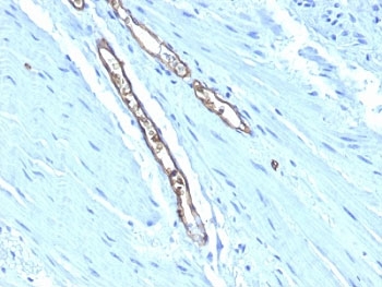 Blood Group A Antibody - Formalin-fixed, paraffin-embedded human colon carcinoma stained with Blood Group Antigen A antibody (HE-193).  This image was taken for the unmodified form of this product. Other forms have not been tested.