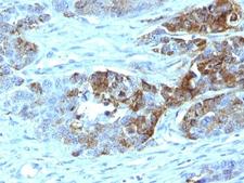 Blood Group H Antibody - Formalin-fixed, paraffin-embedded human colon carcinoma stained with Blood Group Antigen H Type 2 antibody (19-OLE).  This image was taken for the unmodified form of this product. Other forms have not been tested.
