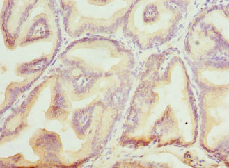 BLVRA Antibody - Immunohistochemistry of paraffin-embedded human prostata cancer at dilution 1:100