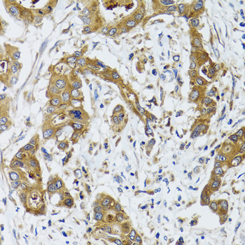 BLZF1 Antibody - Immunohistochemistry of paraffin-embedded human colon carcinoma tissue.