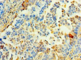 BM022 / MRPL1 Antibody - Immunohistochemistry of paraffin-embedded human lung tissue using antibody at 1:100 dilution.  This image was taken for the unconjugated form of this product. Other forms have not been tested.