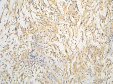 BMAL2 / ARNTL2 Antibody - IHC staining of FFPE human glioma with ARNTL2 antibody at 1ug/ml. HIER: boil tissue sections in pH6, 10mM citrate buffer, for 10-20 min and allow to cool before testing.
