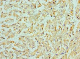 BMF Antibody - Immunohistochemistry of paraffin-embedded human liver cancer using antibody at 1:100 dilution.