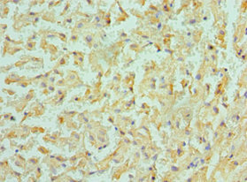 BMF Antibody - Immunohistochemistry of paraffin-embedded human liver cancer using BMF Antibody at dilution of 1:100