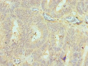 BMF Antibody - Immunohistochemistry of paraffin-embedded human colon cancer using antibody at 1:100 dilution.