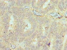 BMF Antibody - Immunohistochemistry of paraffin-embedded human colon cancer using antibody at 1:100 dilution.