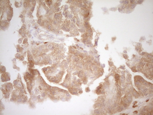 BMF Antibody - Immunohistochemical staining of paraffin-embedded Adenocarcinoma of Human ovary tissue using anti-BMF mouse monoclonal antibody. (Heat-induced epitope retrieval by 1 mM EDTA in 10mM Tris, pH8.5, 120C for 3min,