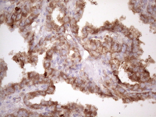 BMF Antibody - Immunohistochemical staining of paraffin-embedded Carcinoma of Human thyroid tissue using anti-BMF mouse monoclonal antibody. (Heat-induced epitope retrieval by 1 mM EDTA in 10mM Tris, pH8.5, 120C for 3min. (1:150)