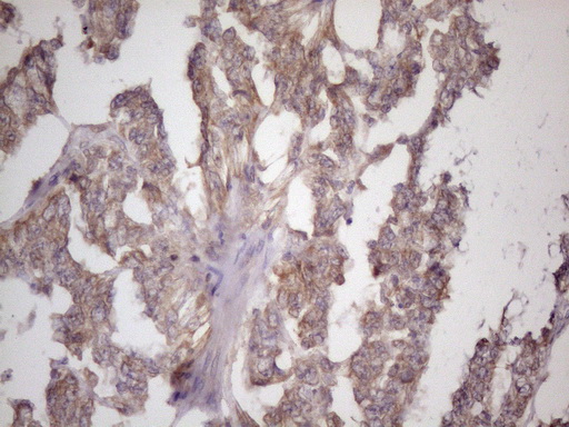 BMF Antibody - Immunohistochemical staining of paraffin-embedded Adenocarcinoma of Human endometrium tissue using anti-BMF mouse monoclonal antibody. (Heat-induced epitope retrieval by 1 mM EDTA in 10mM Tris, pH8.5, 120C for 3min. (1:150)