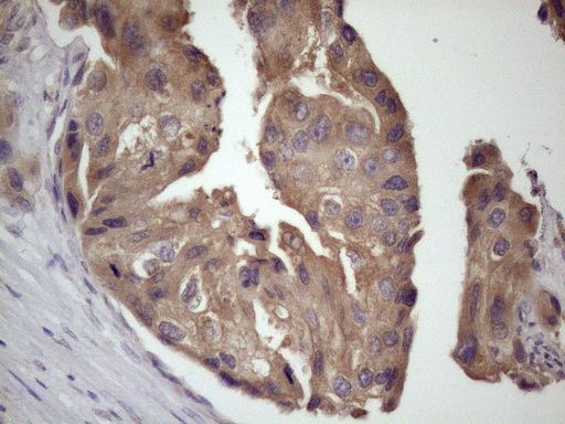 BMF Antibody - Immunohistochemical staining of paraffin-embedded Adenocarcinoma of Human breast tissue using anti-BMF mouse monoclonal antibody. (Heat-induced epitope retrieval by 1 mM EDTA in 10mM Tris, pH8.5, 120C for 3min. (1:150)