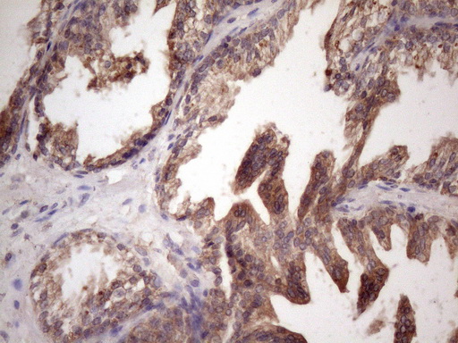BMF Antibody - Immunohistochemical staining of paraffin-embedded Carcinoma of Human prostate tissue using anti-BMF mouse monoclonal antibody. (Heat-induced epitope retrieval by 1 mM EDTA in 10mM Tris, pH8.5, 120C for 3min. (1:150)