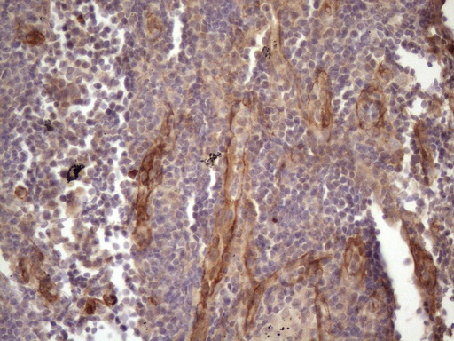 BMF Antibody - Immunohistochemical staining of paraffin-embedded Carcinoma of Human lung tissue using anti-BMF mouse monoclonal antibody. (Heat-induced epitope retrieval by 1 mM EDTA in 10mM Tris, pH8.5, 120C for 3min. (1:150)