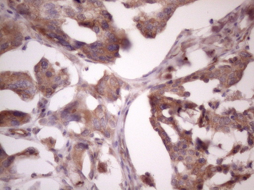 BMF Antibody - Immunohistochemical staining of paraffin-embedded Adenocarcinoma of Human ovary tissue using anti-BMF mouse monoclonal antibody. (Heat-induced epitope retrieval by 1 mM EDTA in 10mM Tris, pH8.5, 120C for 3min. (1:150)