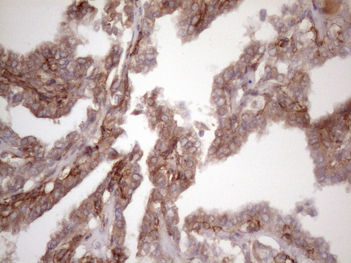 BMF Antibody - Immunohistochemical staining of paraffin-embedded Carcinoma of Human thyroid tissue using anti-BMF mouse monoclonal antibody. (Heat-induced epitope retrieval by 1 mM EDTA in 10mM Tris, pH8.5, 120C for 3min. (1:150)