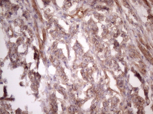 BMF Antibody - Immunohistochemical staining of paraffin-embedded Adenocarcinoma of Human endometrium tissue using anti-BMF mouse monoclonal antibody. (Heat-induced epitope retrieval by 1 mM EDTA in 10mM Tris, pH8.5, 120C for 3min. (1:150)