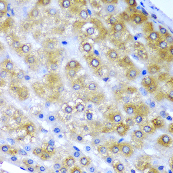 BMF Antibody - Immunohistochemistry of paraffin-embedded human liver cancer tissue.