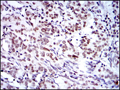BMI1 / PCGF4 Antibody - IHC of paraffin-embedded cervical cancer tissues using BMI1 mouse monoclonal antibody with DAB staining.