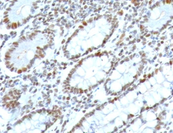 BMI1 / PCGF4 Antibody - IHC testing of FFPE human colon carcinoma with BMI1 antibody (clone PGRF4-1). HIER: boil tissue sections in pH6, 10mM citrate buffer, for 10-20 min followed by cooling at RT for 20 min.
