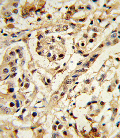 BMI1 / PCGF4 Antibody - Formalin-fixed and paraffin-embedded human breast carcinoma reacted with BMI1 Antibody, which was peroxidase-conjugated to the secondary antibody, followed by DAB staining. This data demonstrates the use of this antibody for immunohistochemistry; clinical relevance has not been evaluated.