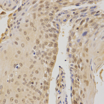 BMI1 / PCGF4 Antibody - Immunohistochemistry of paraffin-embedded human esophageal cancer using BMI1 antibody at dilution of 1:200 (x400 lens).