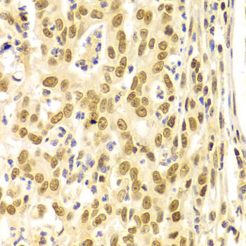 BMI1 / PCGF4 Antibody - Immunohistochemistry of paraffin-embedded Human gastric cancer tissue.