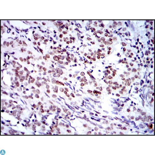 BMI1 / PCGF4 Antibody - Immunohistochemistry (IHC) analysis of paraffin-embedded cervical cancer tissues with DAB staining using Bmi-1 Monoclonal Antibody.