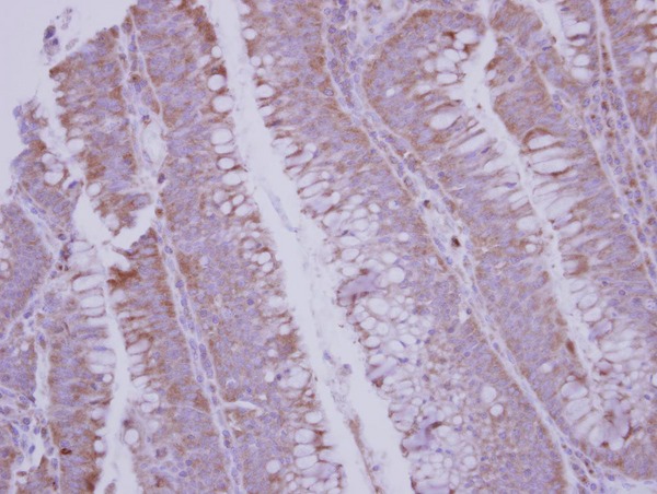 BMP10 Antibody - IHC of paraffin-embedded Colon ca using BMP10 antibody at 1:250 dilution.