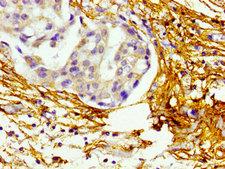 BMP10 Antibody - Immunohistochemistry image of paraffin-embedded human breast cancer at a dilution of 1:100