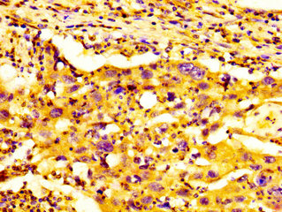 BMP12 / GDF7 Antibody - Immunohistochemistry image at a dilution of 1:300 and staining in paraffin-embedded human lung cancer performed on a Leica BondTM system. After dewaxing and hydration, antigen retrieval was mediated by high pressure in a citrate buffer (pH 6.0) . Section was blocked with 10% normal goat serum 30min at RT. Then primary antibody (1% BSA) was incubated at 4 °C overnight. The primary is detected by a biotinylated secondary antibody and visualized using an HRP conjugated SP system.