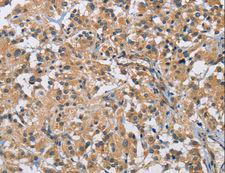 BMP15 Antibody - Immunohistochemistry of paraffin-embedded Human thyroid cancer using BMP15 Polyclonal Antibody at dilution of 1:40.