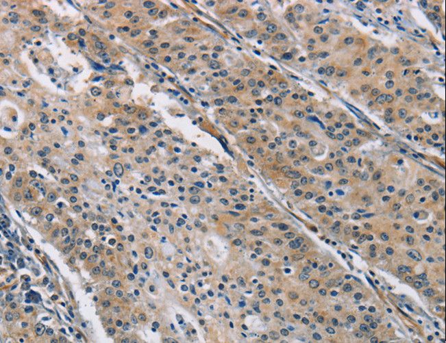BMP15 Antibody - Immunohistochemistry of paraffin-embedded Human gastric cancer using BMP15 Polyclonal Antibody at dilution of 1:40.