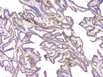 BMP15 Antibody - IHC staining of FFPE human thyroid cancer with BMP15 antibody at 1ug/ml. HIER: boil tissue sections in pH6, 10mM citrate buffer, for 10-20 min and allow to cool before testing.