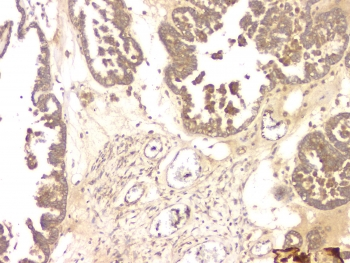 BMP15 Antibody - IHC staining of FFPE human ovarian cancer with BMP15 antibody at 1ug/ml. HIER: boil tissue sections in pH6, 10mM citrate buffer, for 10-20 min and allow to cool before testing.