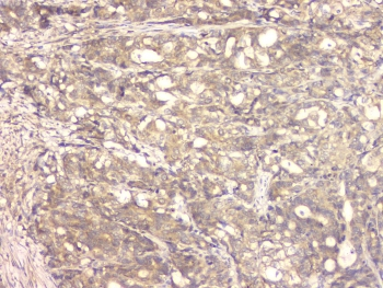 BMP15 Antibody - IHC staining of FFPE human stomach cancer with BMP15 antibody at 1ug/ml. HIER: boil tissue sections in pH6, 10mM citrate buffer, for 10-20 min and allow to cool before testing.