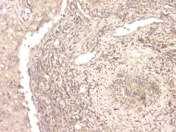 BMP15 Antibody - IHC staining of FFPE human lung cancer with BMP15 antibody at 1ug/ml. HIER: boil tissue sections in pH6, 10mM citrate buffer, for 10-20 min and allow to cool before testing.